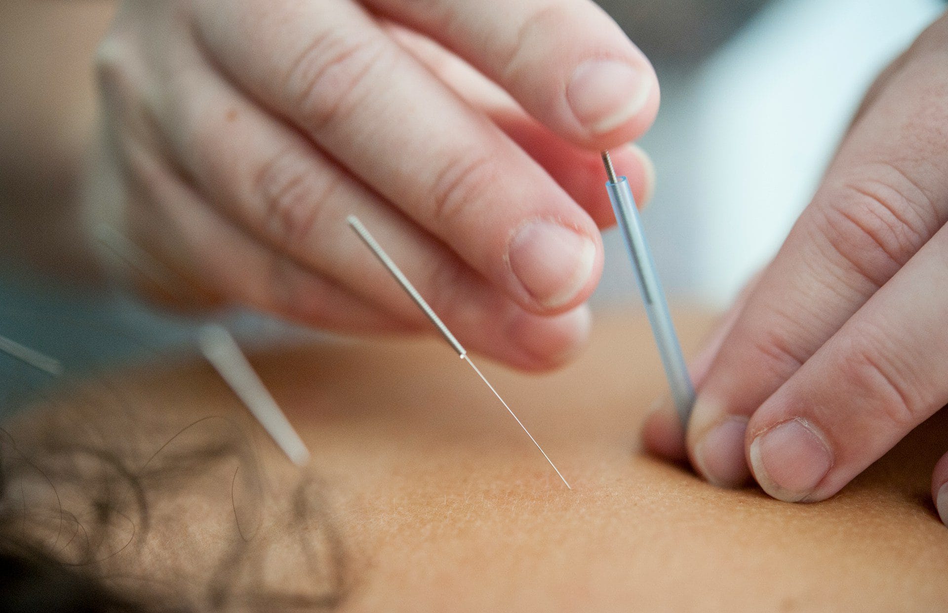 Myotherapy dry needling at Logan Myotherapy.